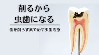 削るから虫歯になる｜削らない虫歯治療